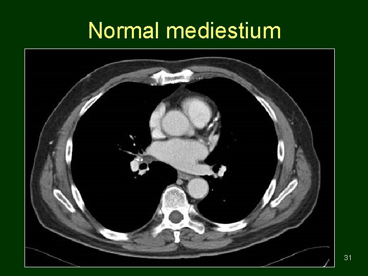 Normal mediestium 31 