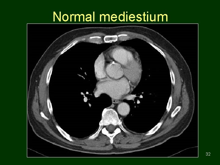 Normal mediestium 32 