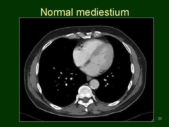 Normal mediestium 33 