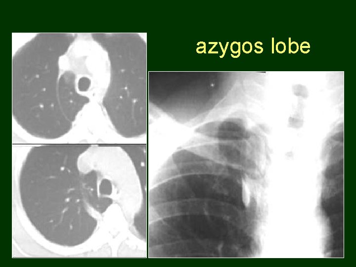 azygos lobe 40 