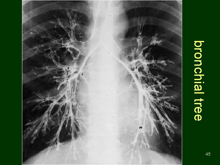 bronchial tree 45 