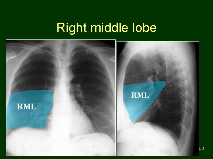 Right middle lobe 50 