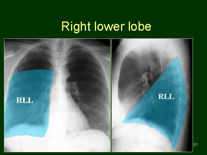 Right lower lobe 51 