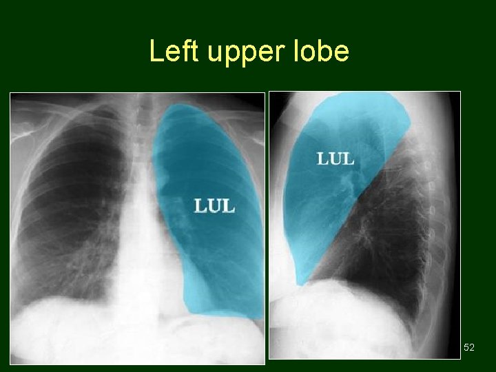 Left upper lobe 52 