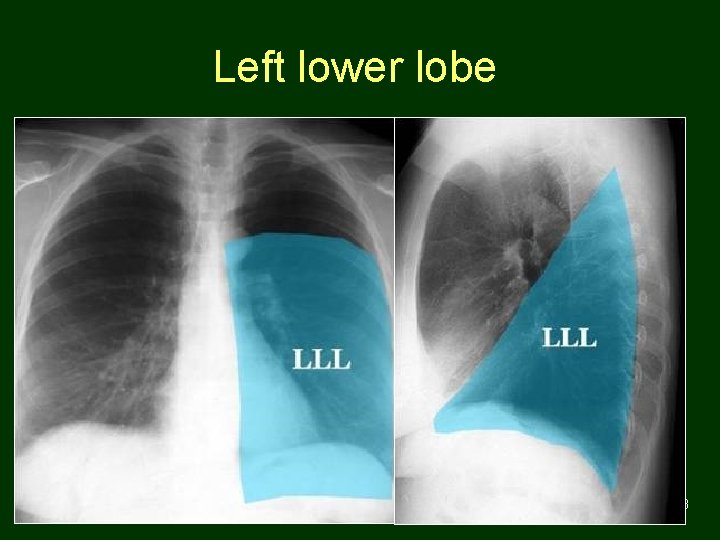 Left lower lobe 53 