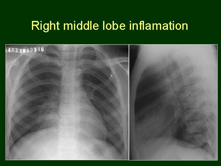 Right middle lobe inflamation 57 
