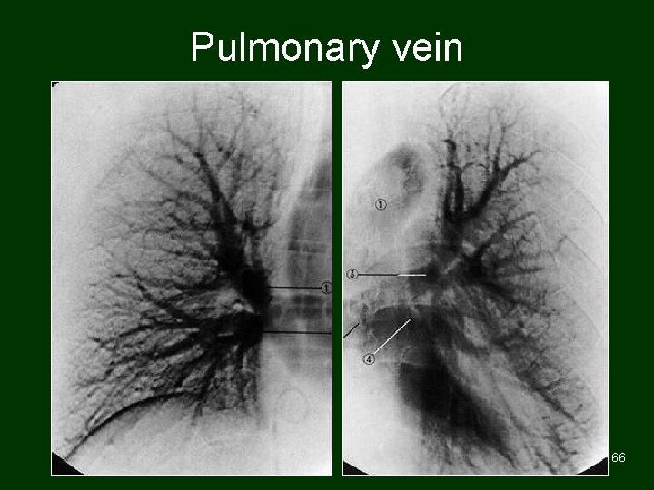 Pulmonary vein 66 