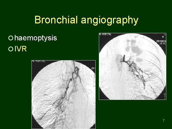 Bronchial angiography ¡ haemoptysis ¡ IVR 7 