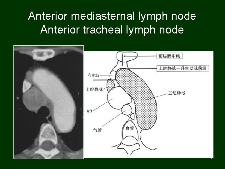 Anterior mediasternal lymph node Anterior tracheal lymph node 71 