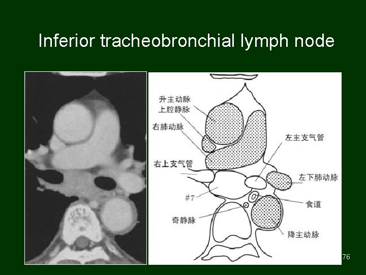 Inferior tracheobronchial lymph node 76 