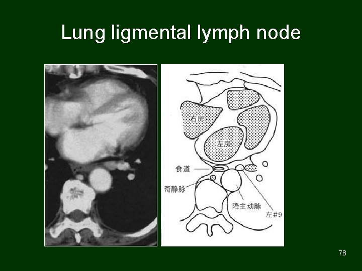 Lung ligmental lymph node 78 