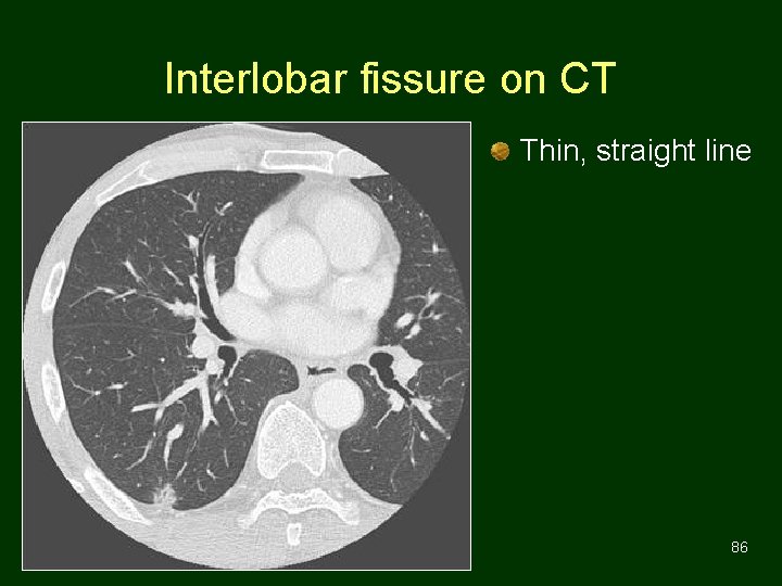 Interlobar fissure on CT Thin, straight line 86 