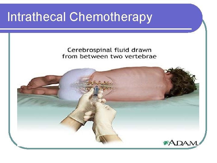 Intrathecal Chemotherapy 