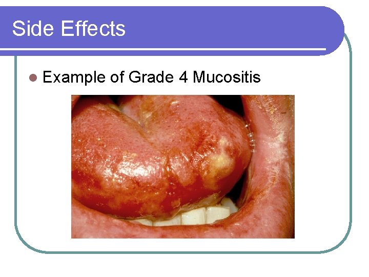 Side Effects l Example of Grade 4 Mucositis 