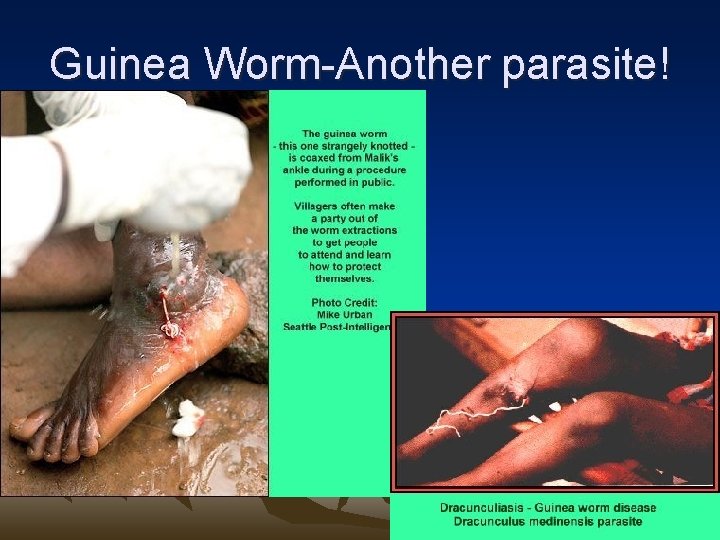 Guinea Worm-Another parasite! 