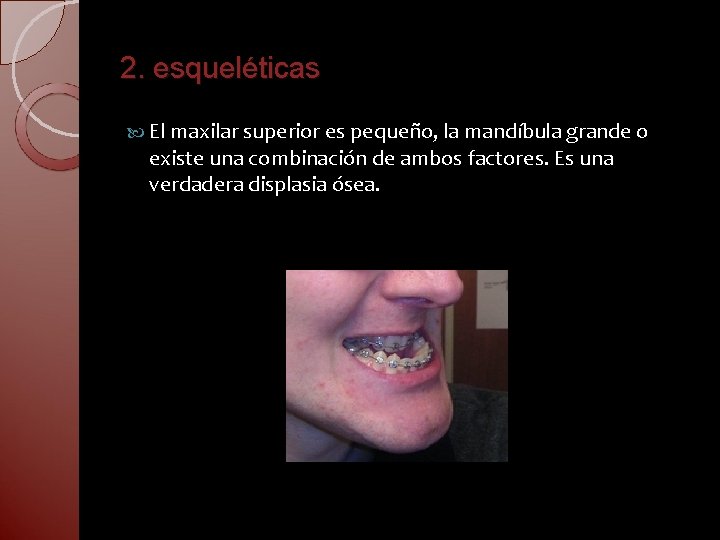 2. esqueléticas El maxilar superior es pequeño, la mandíbula grande o existe una combinación