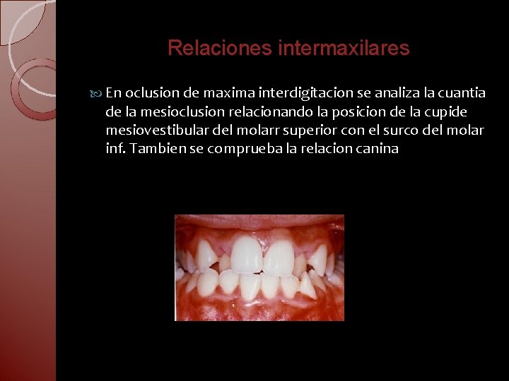 Relaciones intermaxilares En oclusion de maxima interdigitacion se analiza la cuantia de la mesioclusion