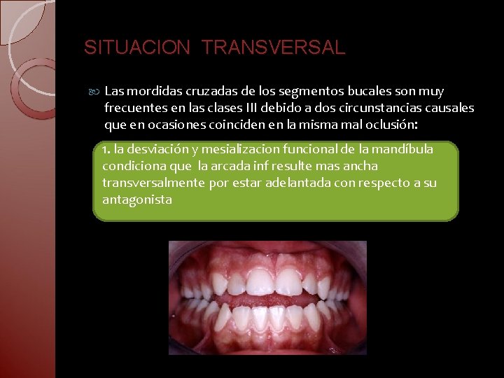 SITUACION TRANSVERSAL Las mordidas cruzadas de los segmentos bucales son muy frecuentes en las