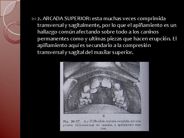  2. ARCADA SUPERIOR: esta muchas veces comprimida transversal y sagitalmente, por lo que