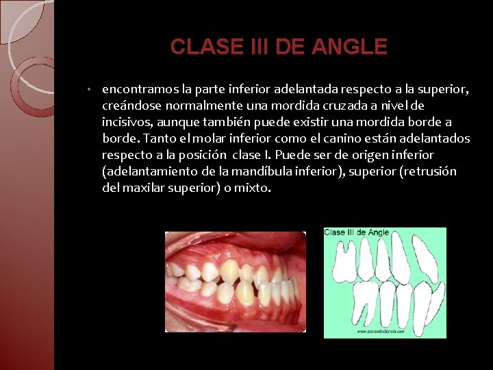 CLASE III DE ANGLE • encontramos la parte inferior adelantada respecto a la superior,