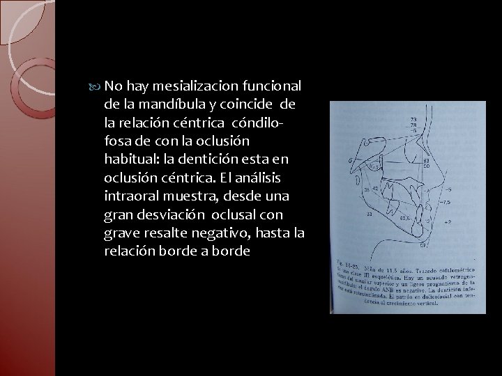  No hay mesializacion funcional de la mandíbula y coincide de la relación céntrica