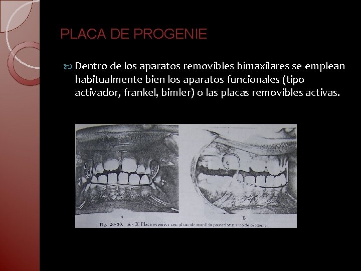 PLACA DE PROGENIE Dentro de los aparatos removibles bimaxilares se emplean habitualmente bien los