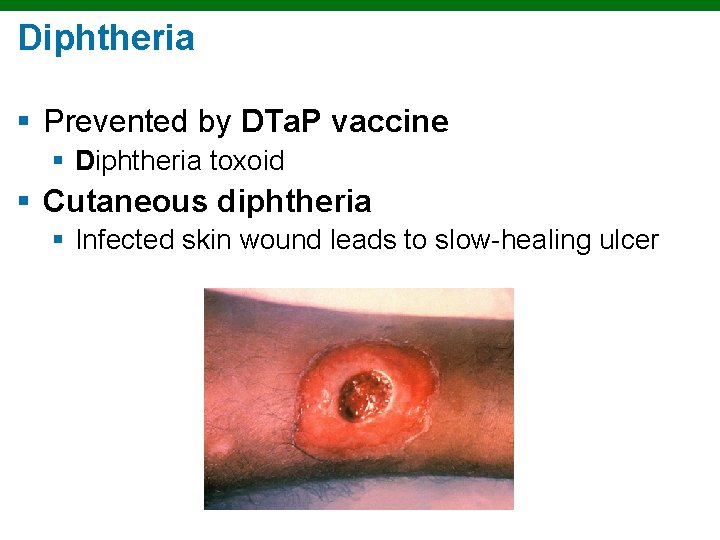 Diphtheria § Prevented by DTa. P vaccine § Diphtheria toxoid § Cutaneous diphtheria §