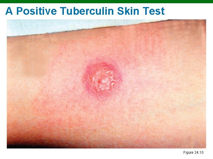 A Positive Tuberculin Skin Test Figure 24. 10 