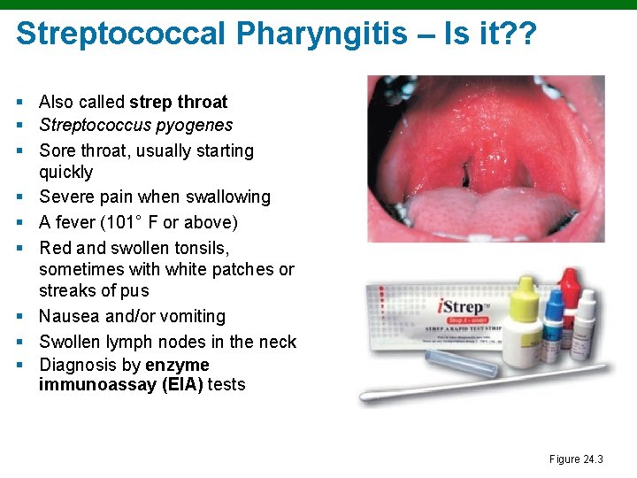 Streptococcal Pharyngitis – Is it? ? § Also called strep throat § Streptococcus pyogenes