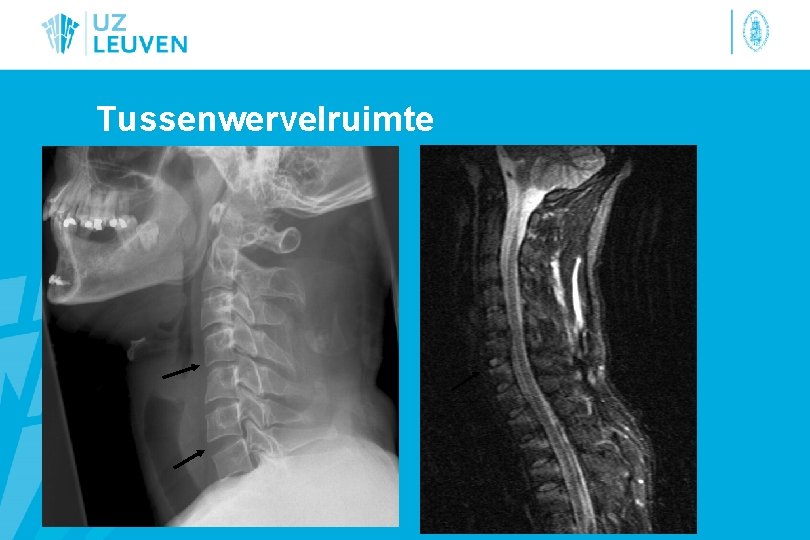 Tussenwervelruimte 