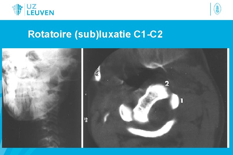 Rotatoire (sub)luxatie C 1 -C 2 