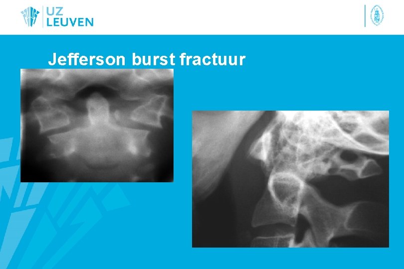 Jefferson burst fractuur 