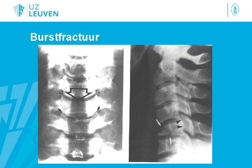Burstfractuur 