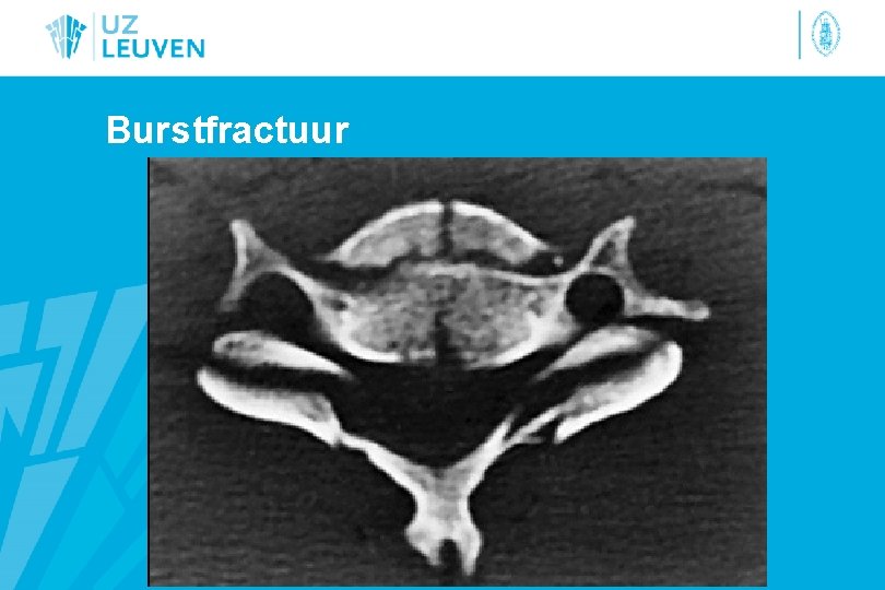 Burstfractuur 
