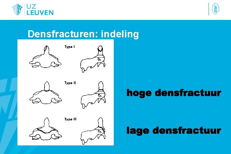 Densfracturen: indeling 