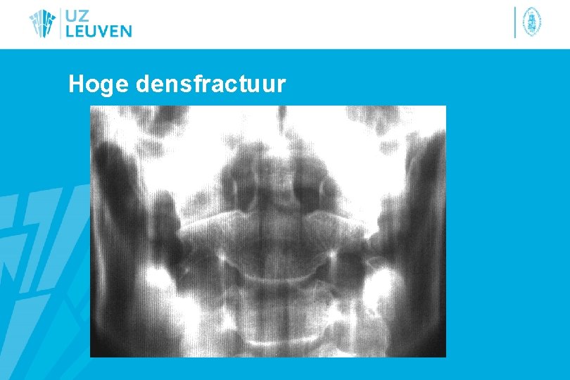 Hoge densfractuur 