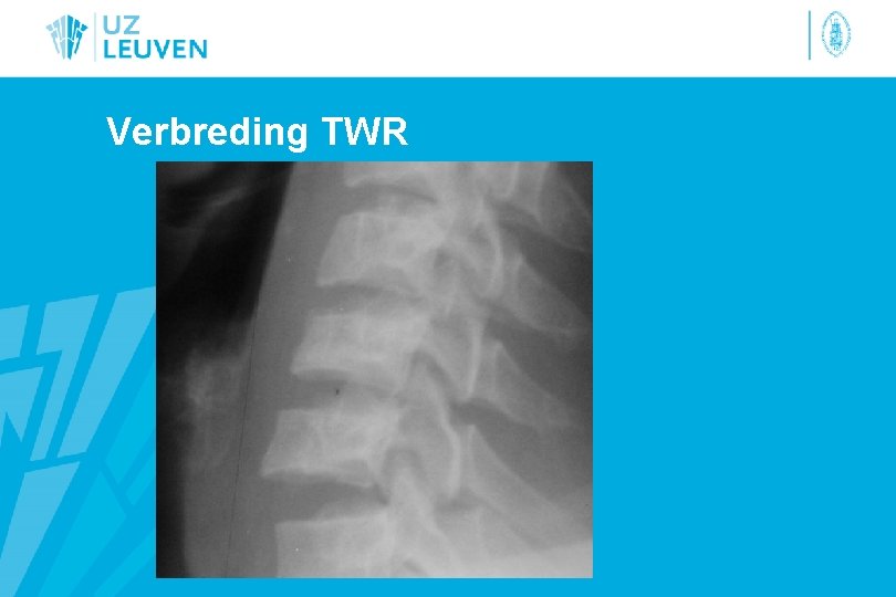 Verbreding TWR 