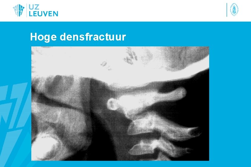 Hoge densfractuur 