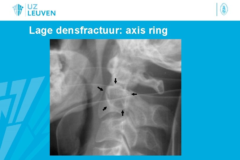 Lage densfractuur: axis ring 