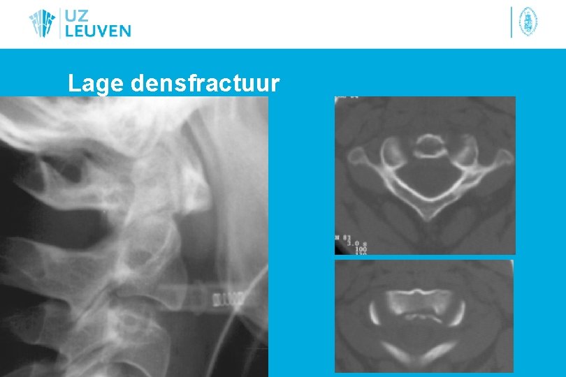 Lage densfractuur 