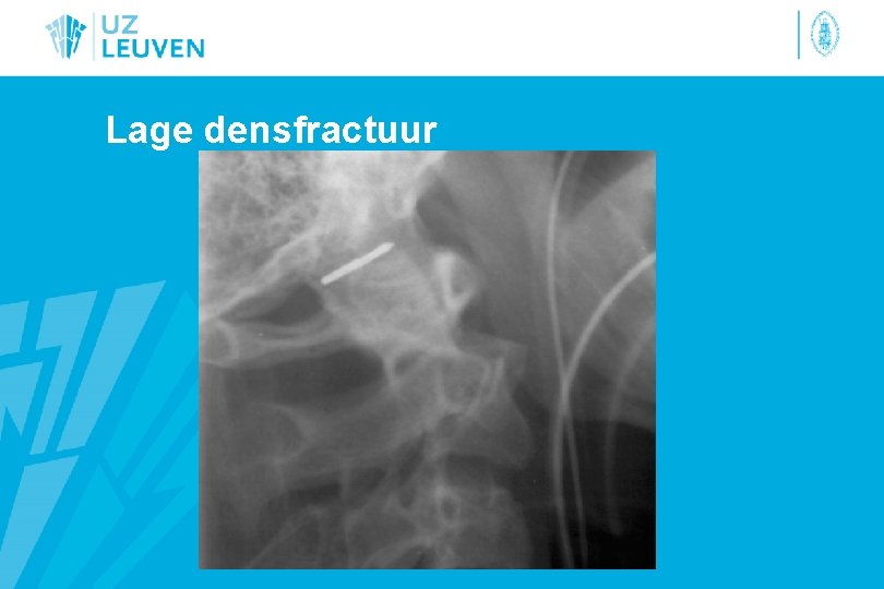 Lage densfractuur 