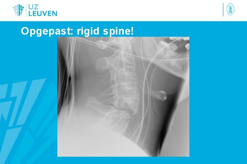 Opgepast: rigid spine! 