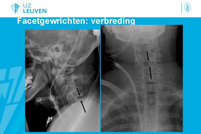 Facetgewrichten: verbreding 