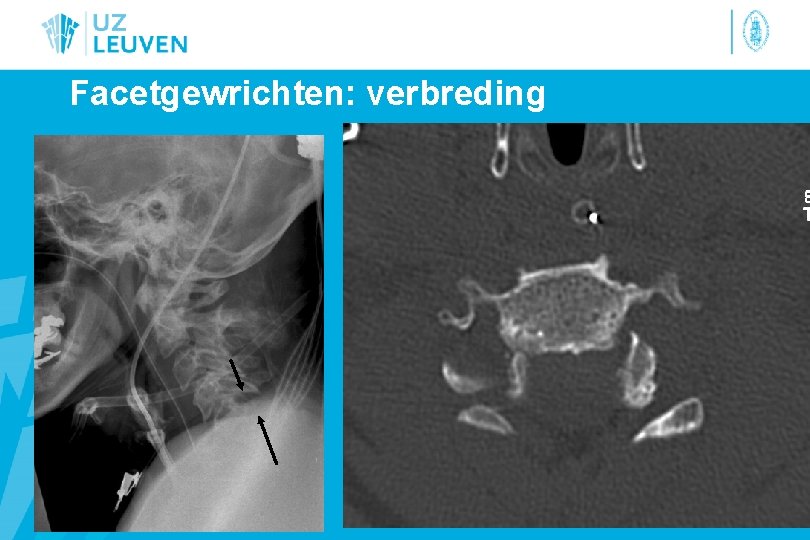 Facetgewrichten: verbreding 