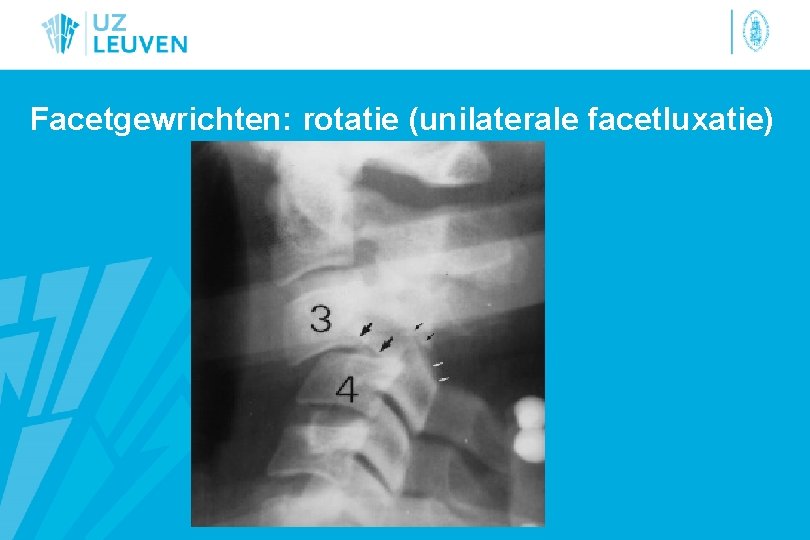 Facetgewrichten: rotatie (unilaterale facetluxatie) 