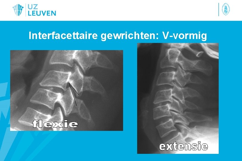 Interfacettaire gewrichten: V-vormig 