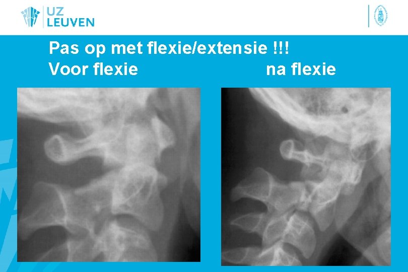 Pas op met flexie/extensie !!! Voor flexie na flexie 