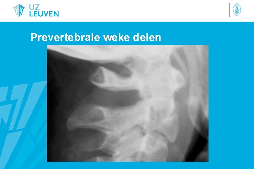 Prevertebrale weke delen 
