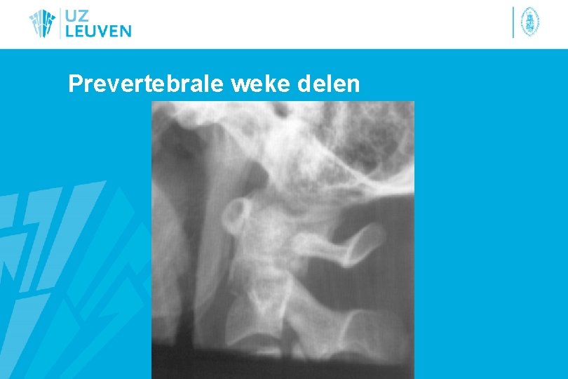 Prevertebrale weke delen 