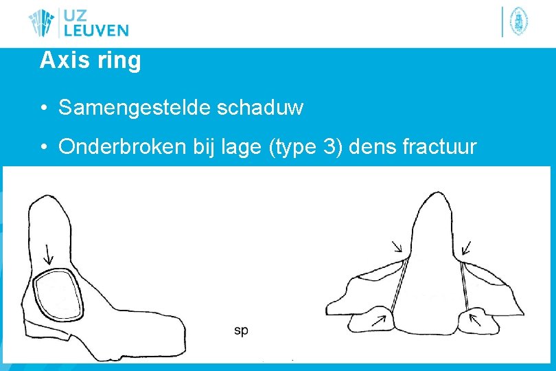 Axis ring • Samengestelde schaduw • Onderbroken bij lage (type 3) dens fractuur 